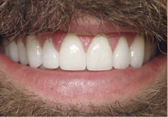 A Logan area patient after professional teeth whitening.